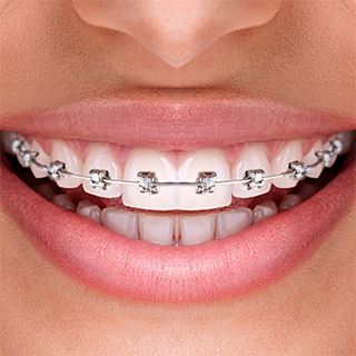 Orthodontic Treatments