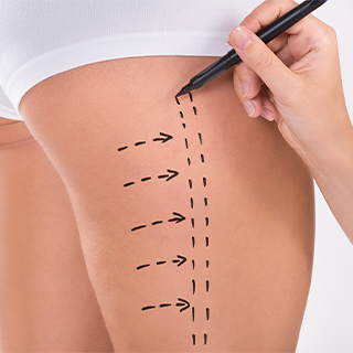 Thigh Lift (Upper Leg Lift- Thigh Lift) Aesthetics