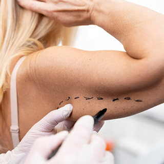 Arm Lift Aesthetics (Brachioplasty)