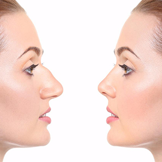 Nose Aesthetics (Rhinoplasty)